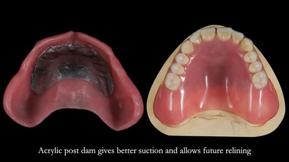 Newsletter 78: What do Clark Gable and a Locator® overdenture have in common?