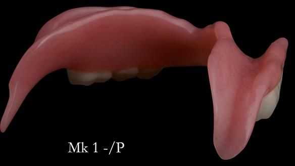 Newsletter 52 Managing Jo’s failing dentition with extractions and Mk 1/Mk 2 complete upper dentures and lower partial dentures FULL PROTOCOL