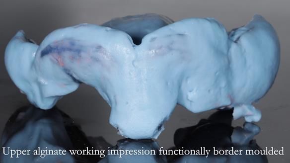 Finlay's Newsletter 58 Gasket upper partial denture for Zoe