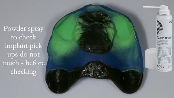 Newsletter 57 showcases the making and fitting process of implant-supported complete dentures for Alisdair
