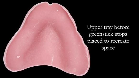 Newsletter 54 case presentation upper complete denture and lower Scandinavian designed hygienic partial denture for David