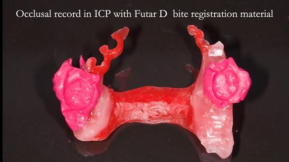 Solving Sue's failed implants with metal based RPD - full protocol Newsletter 43