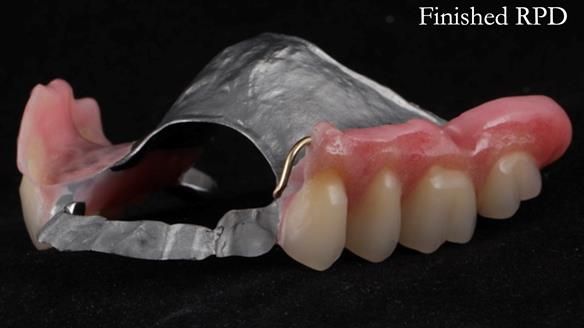 Finlay's Newsletter 60 Sylvia's upper Kennedy Class 2 Mod 1 metal based upper RPD