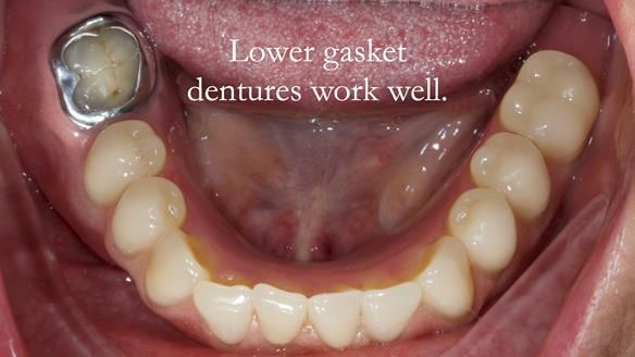 Finlay's Newsletter 58 Gasket upper partial denture for Zoe