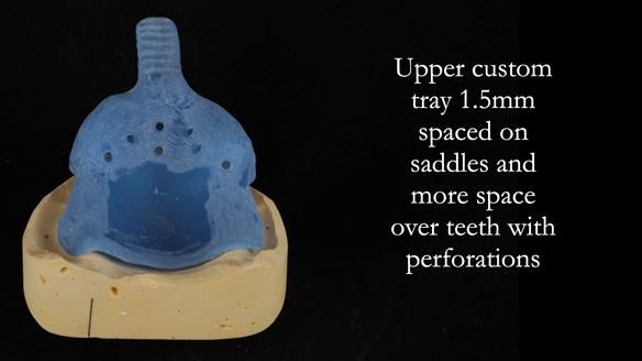Newsletter 56 showing the making and fitting of a bilateral free end saddle upper removable partial denture (RPD) for patient with pemphigus