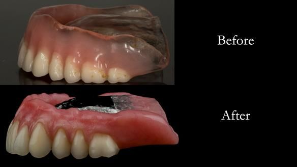 Lip support improved