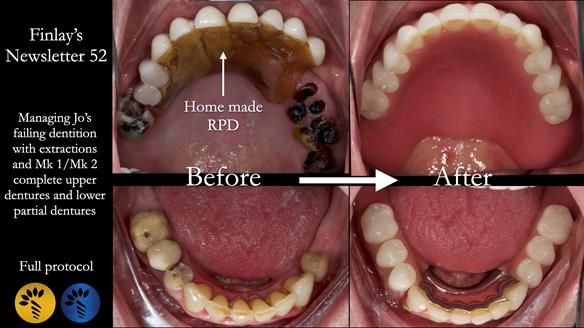 Newsletter 52 Managing Jo’s failing dentition with extractions and Mk 1/Mk 2 complete upper dentures and lower partial dentures FULL PROTOCOL