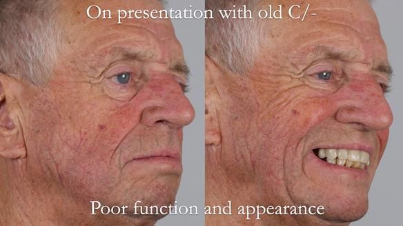 Newsletter 54 case presentation upper complete denture and lower Scandinavian designed hygienic partial denture for David