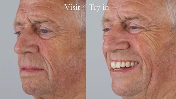 Newsletter 54 case presentation upper complete denture and lower Scandinavian designed hygienic partial denture for David