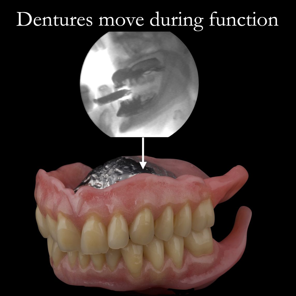 Dentures move during function