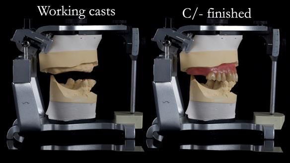 Newsletter 54 case presentation upper complete denture and lower Scandinavian designed hygienic partial denture for David