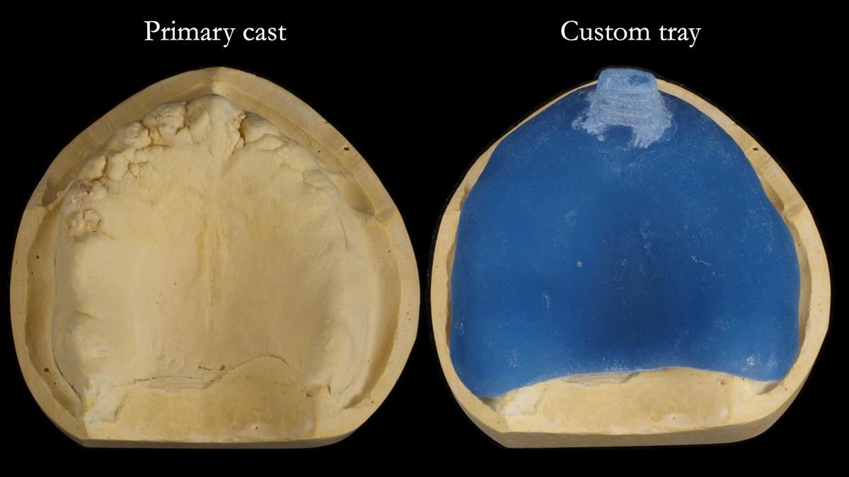 Fin’s Newsletter 88 — Complete dentures - full protocol… he rearranged his own teeth!