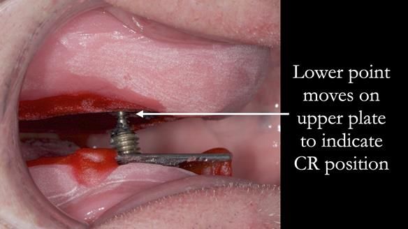 Complete denture Class II div 2 deep overbite Newsletter 39