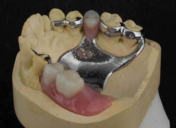 Figure 78 Finished definitive partial denture. Scandinavian design - keeping the denture components 3mm away from the gingival margin