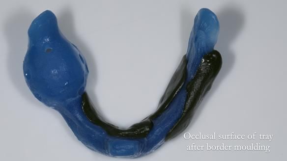 Newsletter 82 Mary - A complete upper and a one-tooth gasket denture