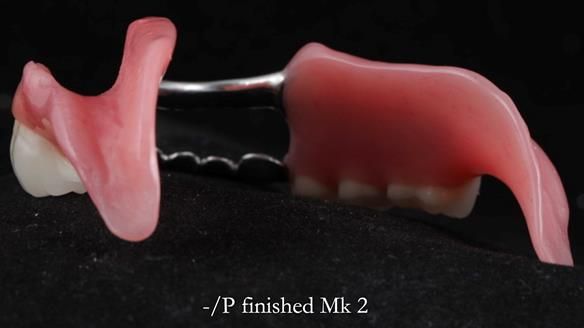 Newsletter 52 Managing Jo’s failing dentition with extractions and Mk 1/Mk 2 complete upper dentures and lower partial dentures FULL PROTOCOL