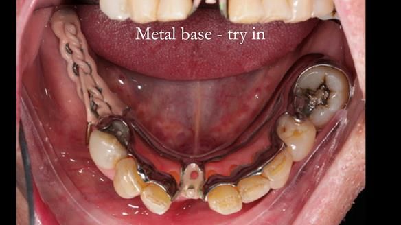 Newsletter 54 case presentation upper complete denture and lower Scandinavian designed hygienic partial denture for David