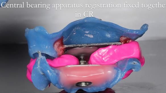 Finlay's Newsletter 58 Gasket upper partial denture for Zoe
