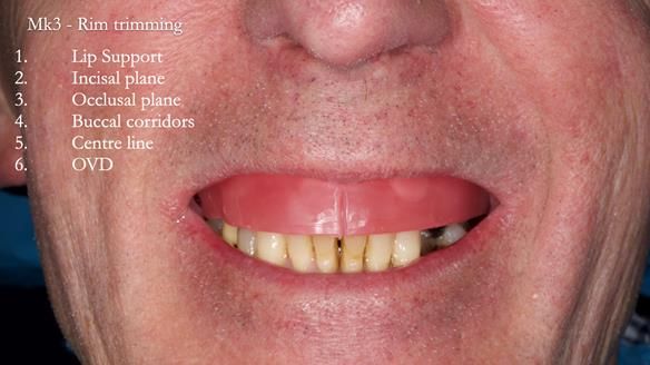 Newsletter 77: Jeremy’s case – immediate complete upper denture