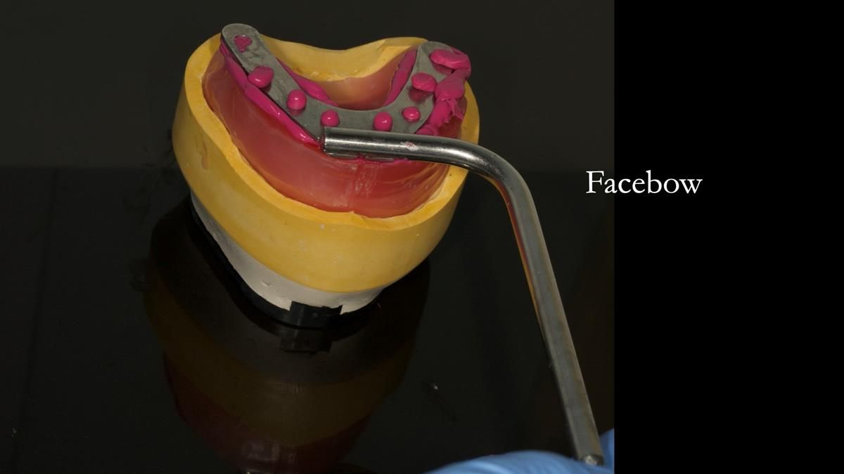 Newsletter 87 – Father Peter: A Partial Denture that needed Minor Miracle