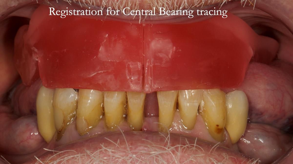 Newsletter 87 – Father Peter: A Partial Denture that needed Minor Miracle
