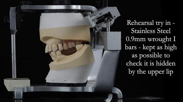 Newsletter 56 showing the making and fitting of a bilateral free end saddle upper removable partial denture (RPD) for patient with pemphigus