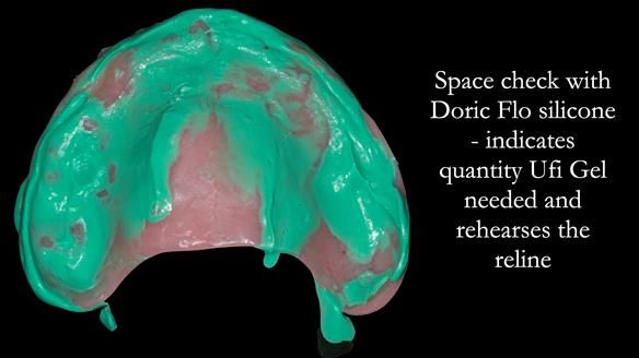 Newsletter 52 Managing Jo’s failing dentition with extractions and Mk 1/Mk 2 complete upper dentures and lower partial dentures FULL PROTOCOL