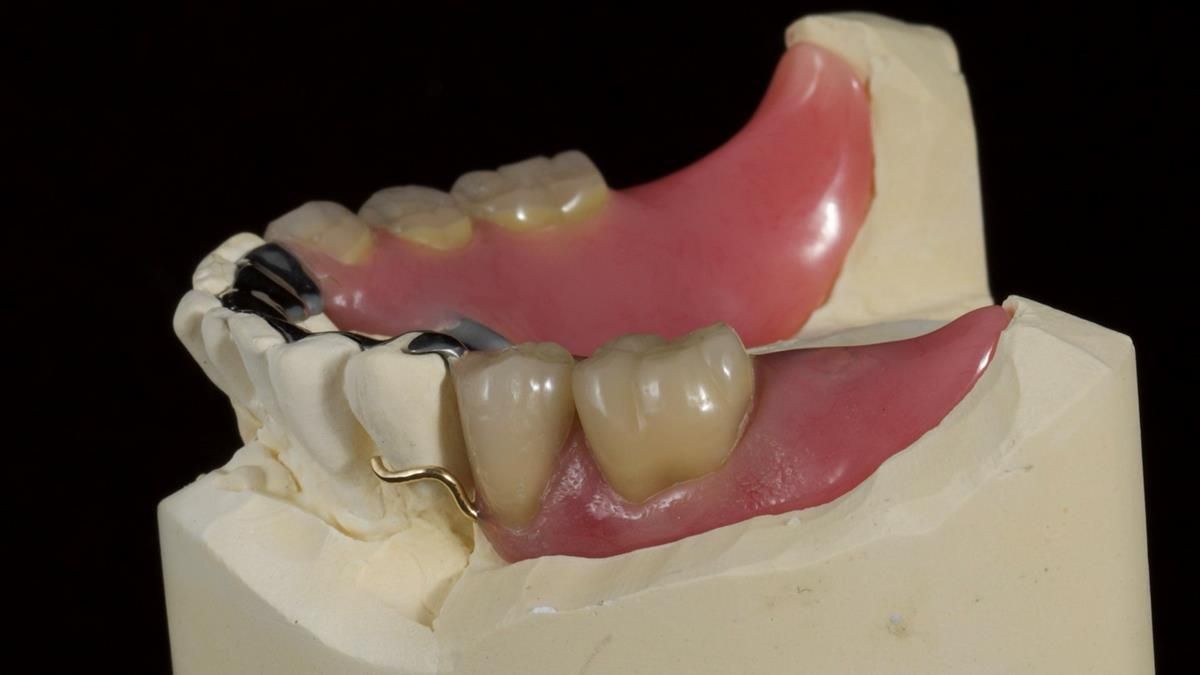 Newsletter 87 – Father Peter: A Partial Denture that needed Minor Miracle