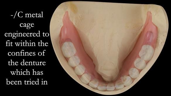 Managing poor implant positioning with complete dentures and Locator attachments - full protocol Newsletter 41