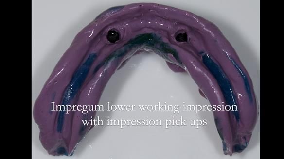 Newsletter 78: What do Clark Gable and a Locator® overdenture have in common?