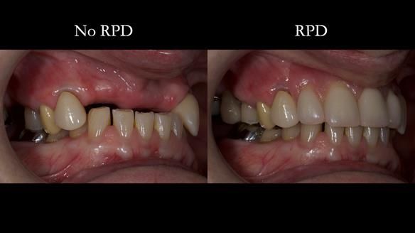 Newsletter 81 - Pam’s Story — how a partial denture changed her life (+ live walkthrough this Thursday)
