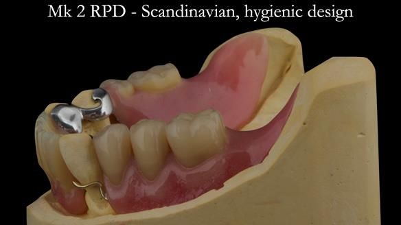 Finlay's Case Study Newsletter 40 - Immediate Mk 1 RPD to Definitive Mk 2 RPD - full protocol