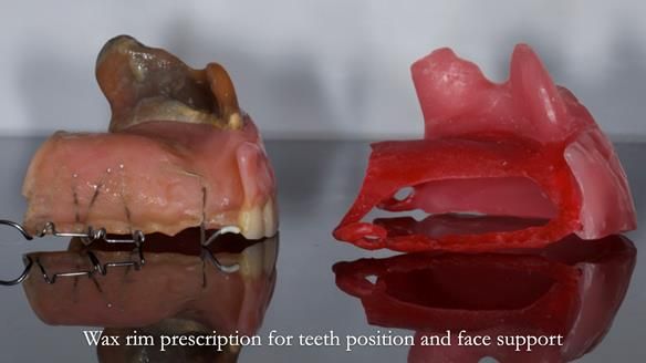 Upper metal base partial denture/occlusal stabilisation splint/obturator - full protocol