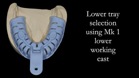 Newsletter 52 Managing Jo’s failing dentition with extractions and Mk 1/Mk 2 complete upper dentures and lower partial dentures FULL PROTOCOL