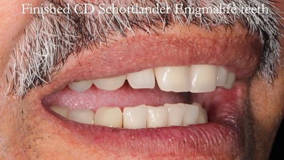 Finlay's Newsletter 62 provision of extractions and metal based complete dentures for Rafique