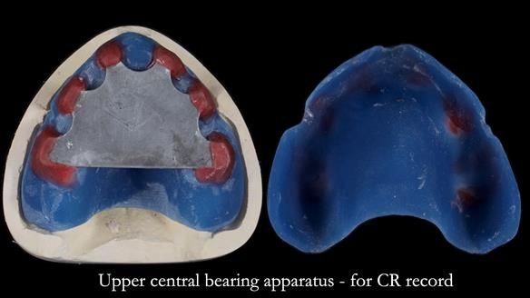 Newsletter 77: Jeremy’s case – immediate complete upper denture