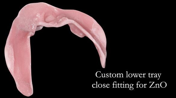 Managing poor implant positioning with complete dentures and Locator attachments - full protocol Newsletter 41