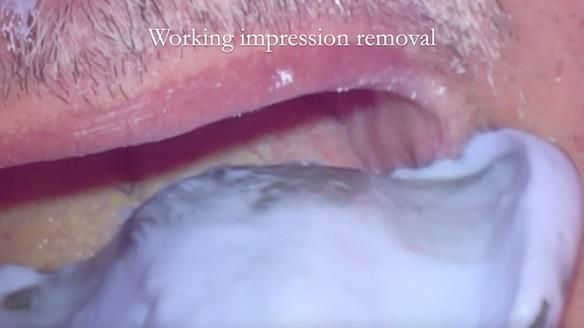 Finlay's Newsletter 62 provision of extractions and metal based complete dentures for Rafique