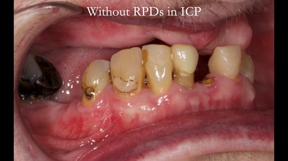 Newsletter 55 Provision of metal based partial dentures for Zephyrine with a repaired cleft lip and palate