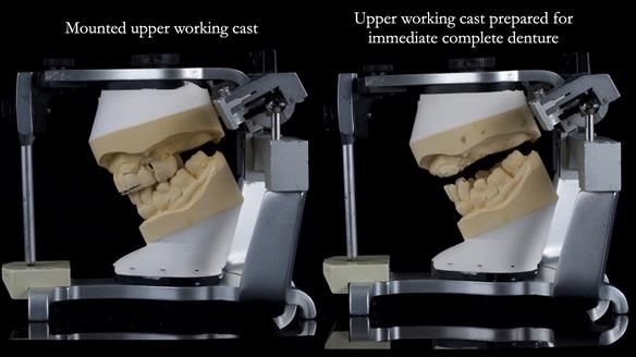 Newsletter 77: Jeremy’s case – immediate complete upper denture