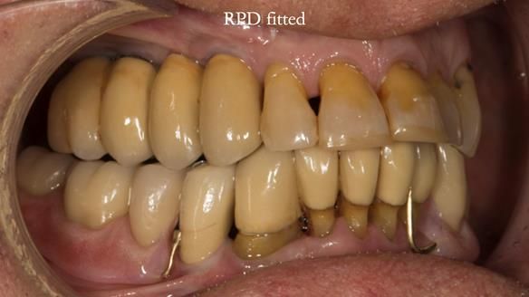 Ken – going downhill, first class