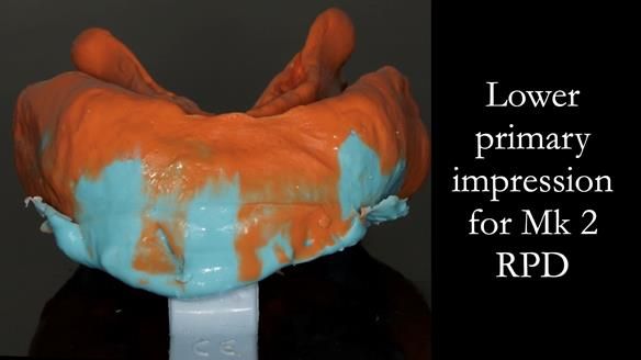 Finlay's Case Study Newsletter 40 - Immediate Mk 1 RPD to Definitive Mk 2 RPD - full protocol