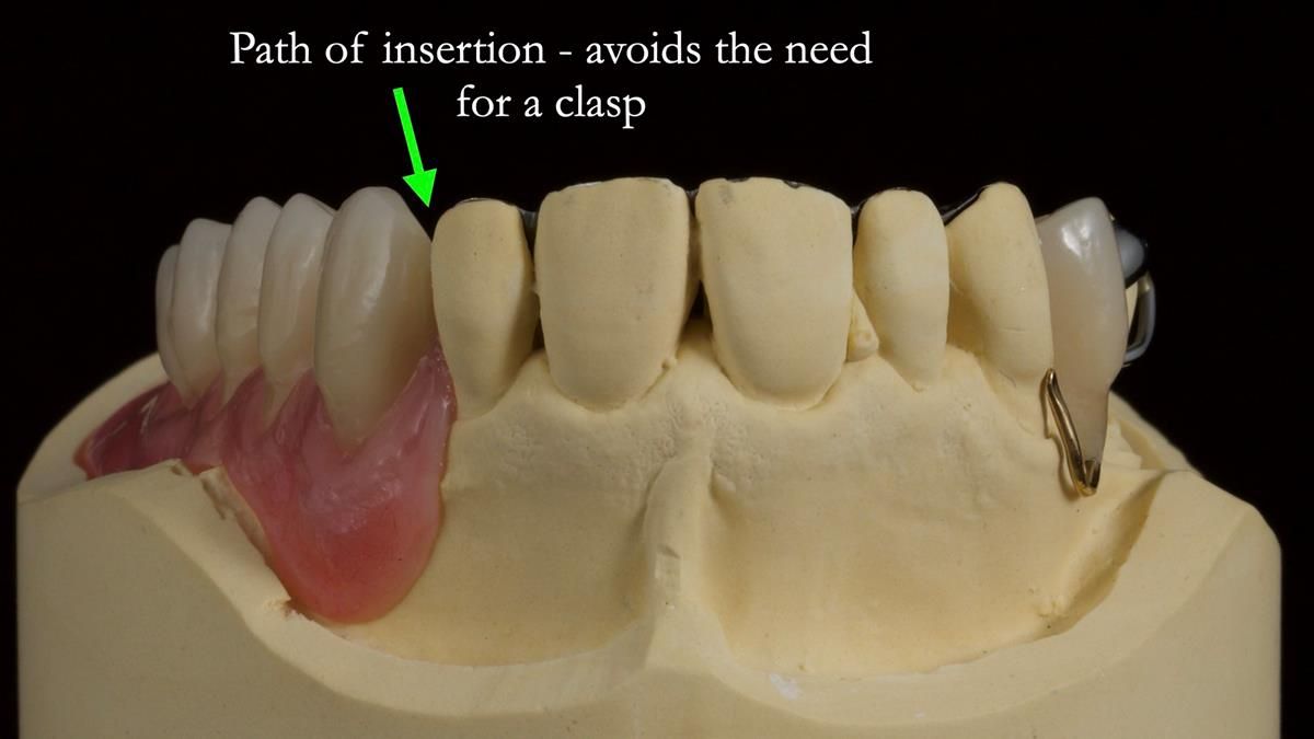 Newsletter 89 – Simon: A Challenging Kennedy Class II Division 1 Upper CoCr Partial Denture with a High Smile Line