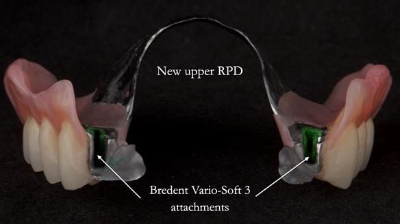 Newsletter 76: Jackie’s case – Telescopic overdenture & precision RPD (the tricky truth!)