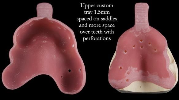 Finlay's Newsletter 60 Sylvia's upper Kennedy Class 2 Mod 1 metal based upper RPD