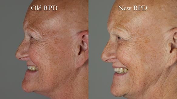Newsletter 81 - Pam’s Story — how a partial denture changed her life (+ live walkthrough this Thursday)