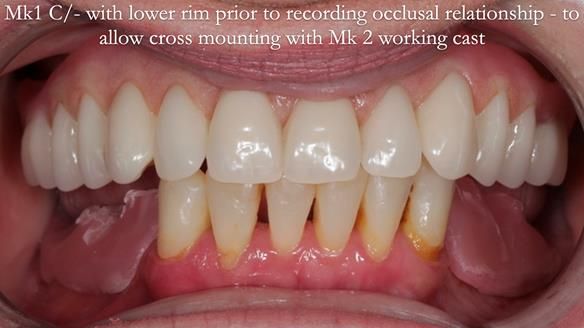 Newsletter 52 Managing Jo’s failing dentition with extractions and Mk 1/Mk 2 complete upper dentures and lower partial dentures FULL PROTOCOL