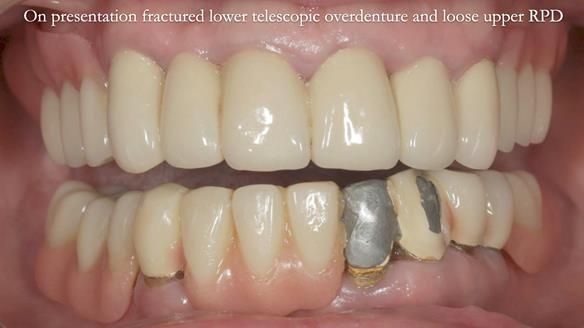 Newsletter 76: Jackie’s case – Telescopic overdenture & precision RPD (the tricky truth!)