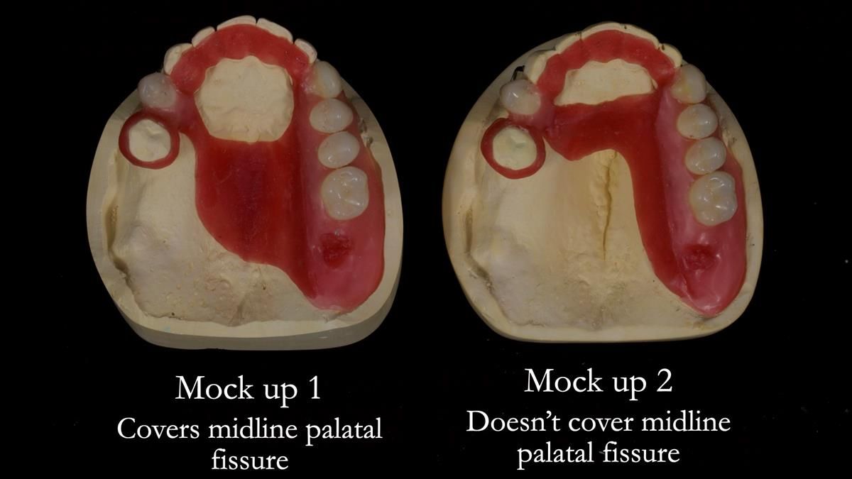 Newsletter 89 – Simon: A Challenging Kennedy Class II Division 1 Upper CoCr Partial Denture with a High Smile Line