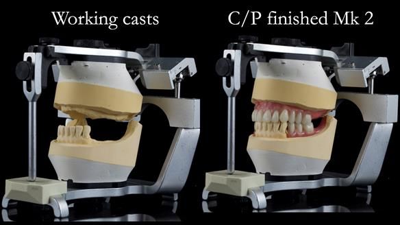 Newsletter 52 Managing Jo’s failing dentition with extractions and Mk 1/Mk 2 complete upper dentures and lower partial dentures FULL PROTOCOL